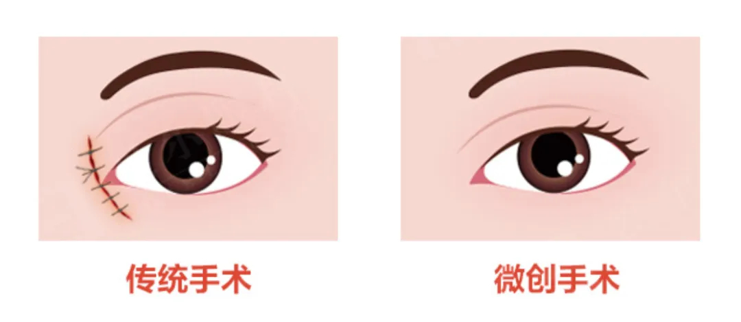 泪道3